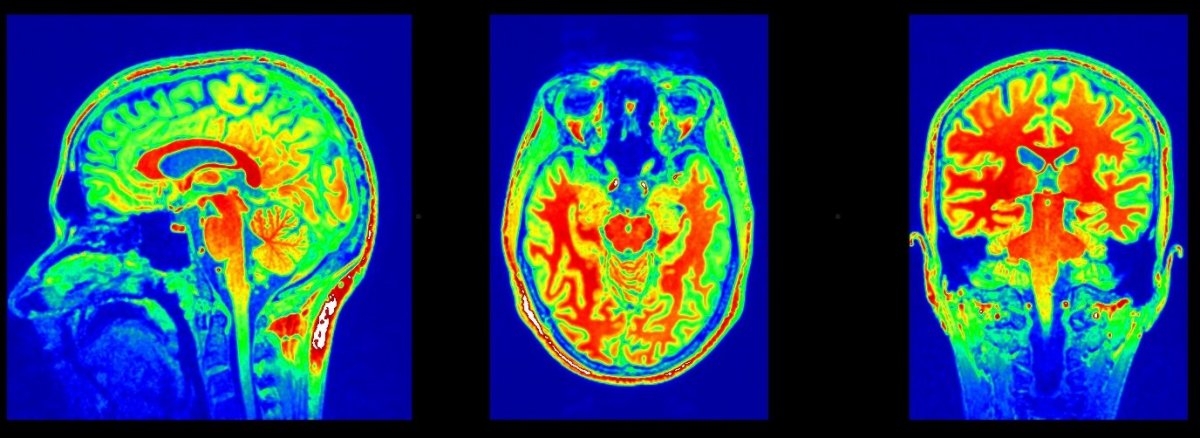Obrazy anatomiczne ludzkiego mózgu uzyskane za pomocą rezonansu magnetycznego